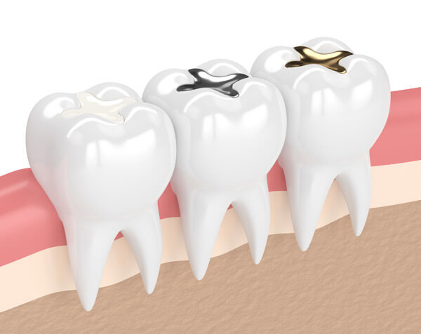 dental filling image