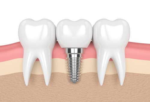 implant 2