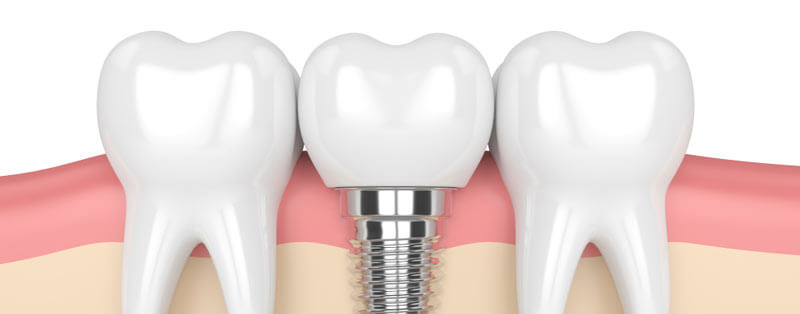 Dental implants example mobile image