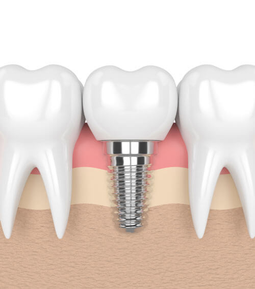 Dental implants example ipad image