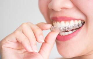 Benefits of Invisalign braces