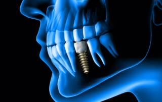 Types of dental implants explained