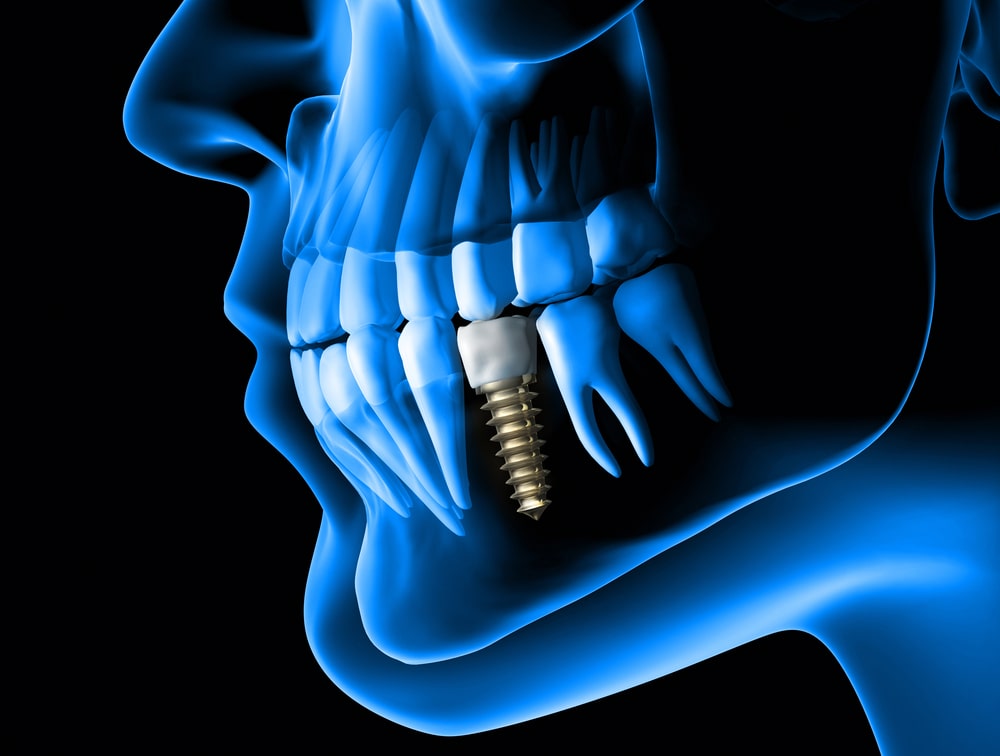 Types of dental implants explained