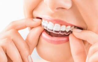 Invisalign nw Calgary