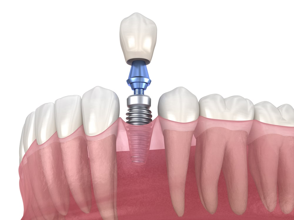 Dental implants