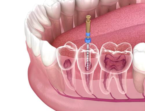 What You Need To Know About Root Canal Treatment Services in Calgary