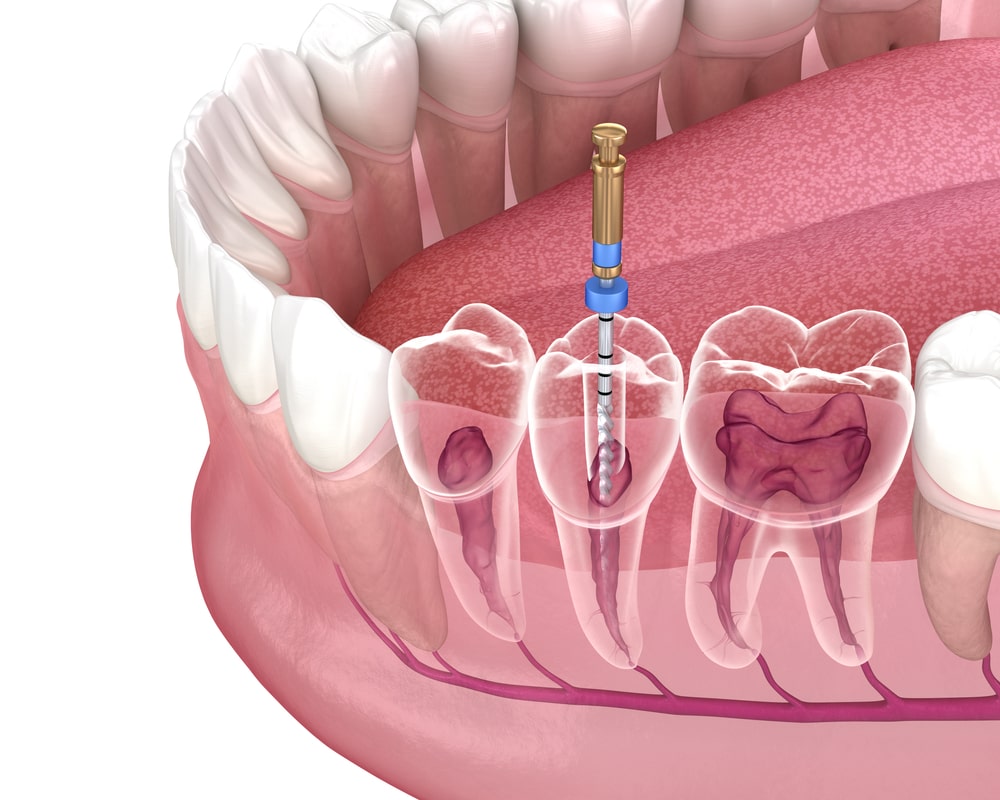 Root Canal Treatment Services in Calgary