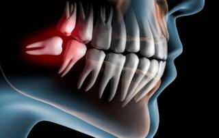 Wisdom Tooth Extraction Services in Calgary