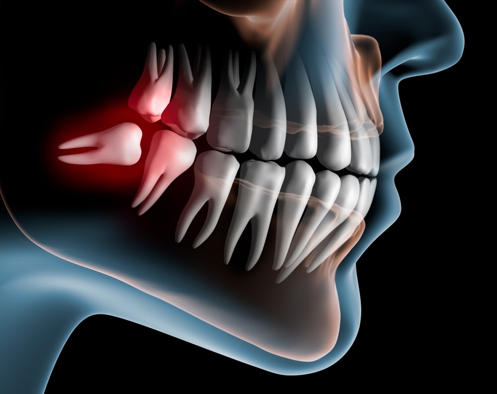 Wisdom Tooth Extraction Services in Calgary