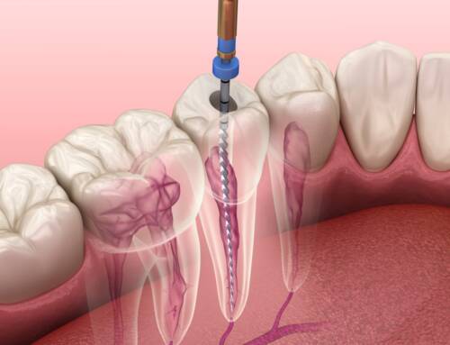 5 Incredible Benefits of a Root Canal Treatment