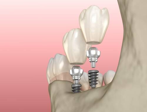 Things You Need to Know About Mini Dental Implants