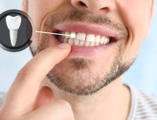 5 Simple Tips for Taking Care of Your Dental Implant