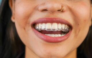 Dental Retainers