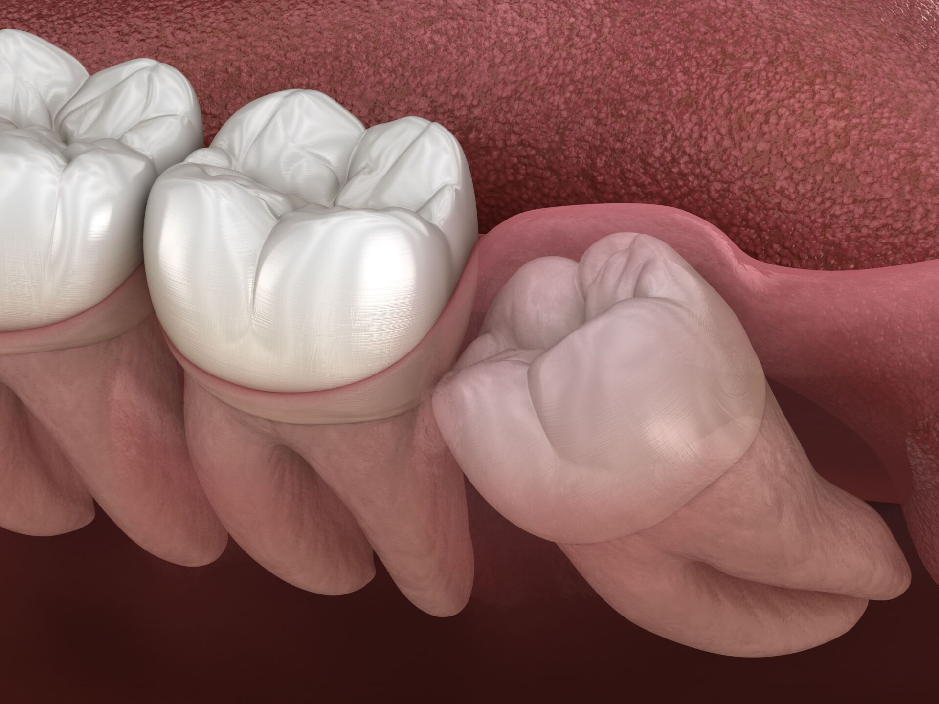Wisdom Teeth Recovery Timeline
