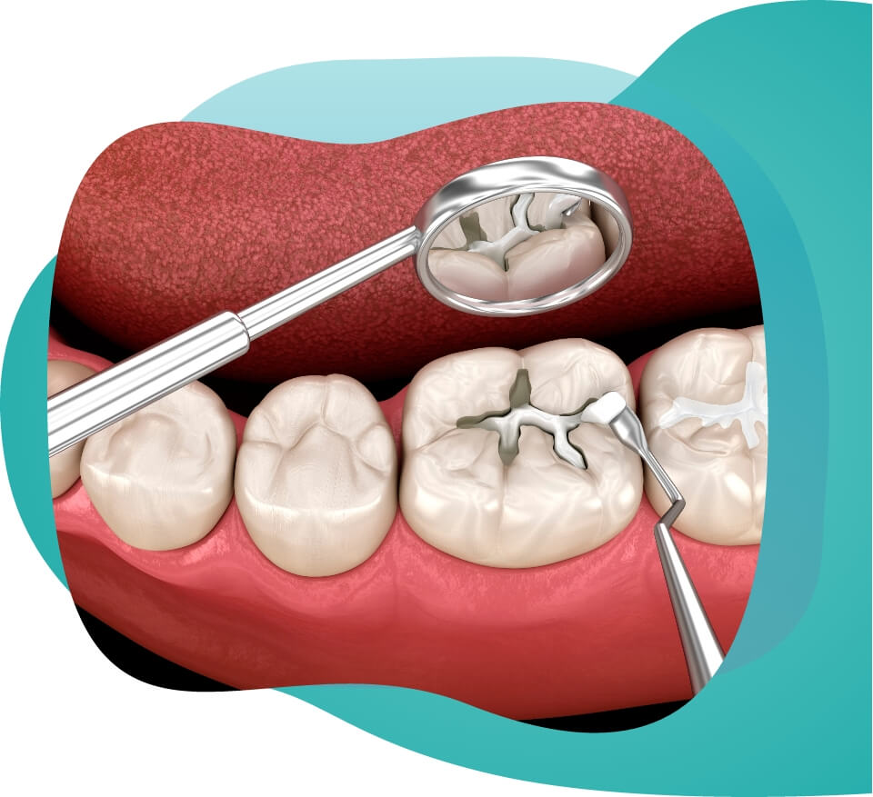 Need a dental filling image