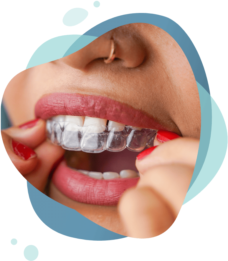 Invisalign® closeup